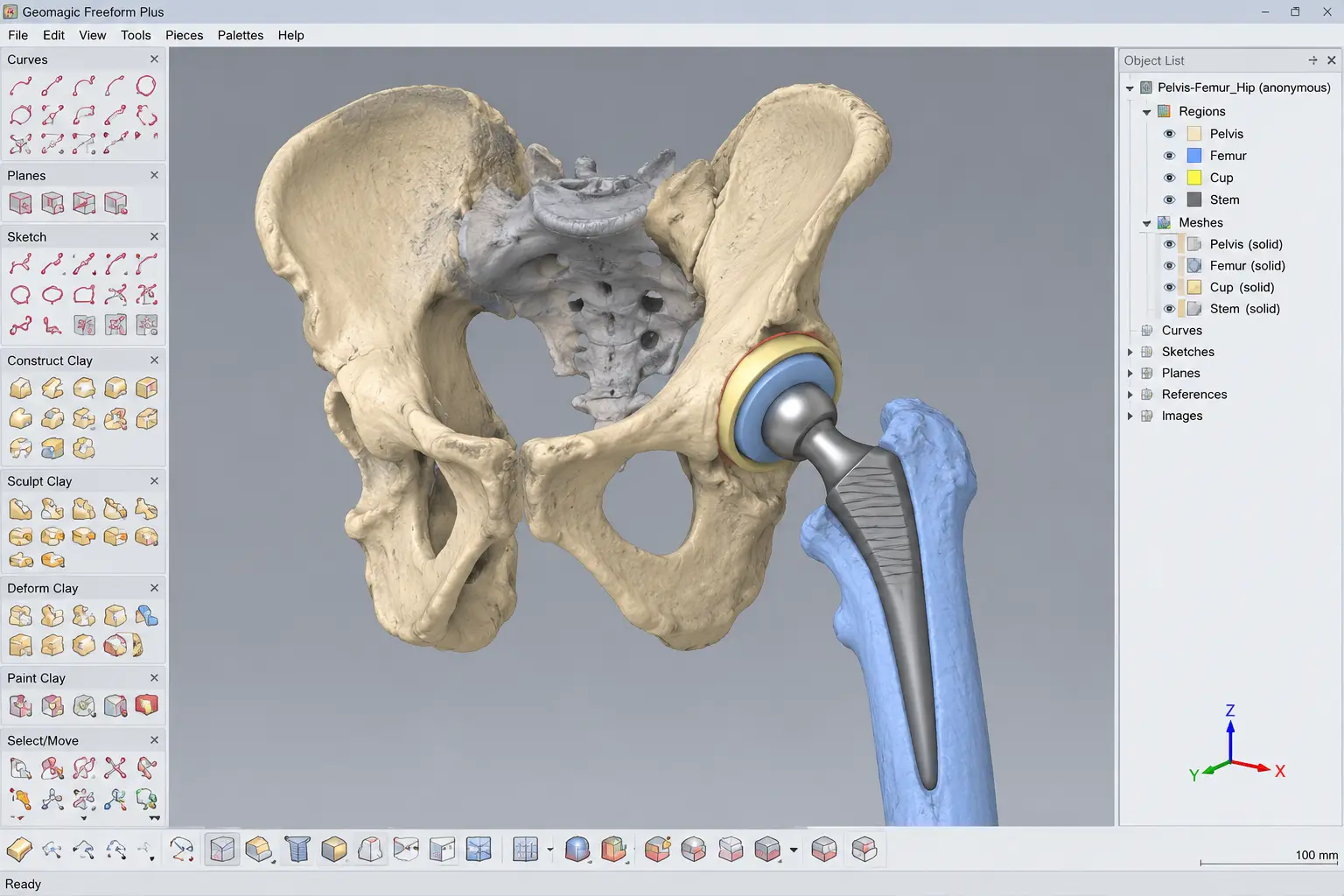 Modélisation 3D d’un bassin et d’un fémur avec cupule et tige de prothèse de hanche, dans une interface inspirée du logiciel Geomagic Freeform.