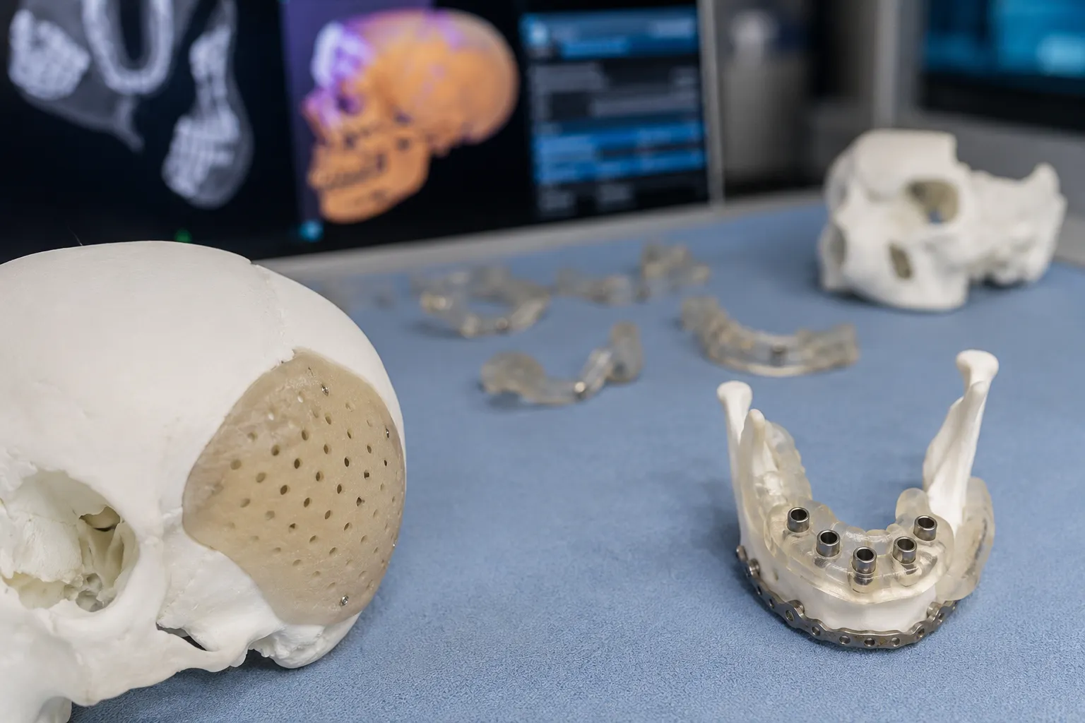 Planification d'une chirurgie ORL avec modèles anatomiques et guides chirurgicaux imprimés en 3D.