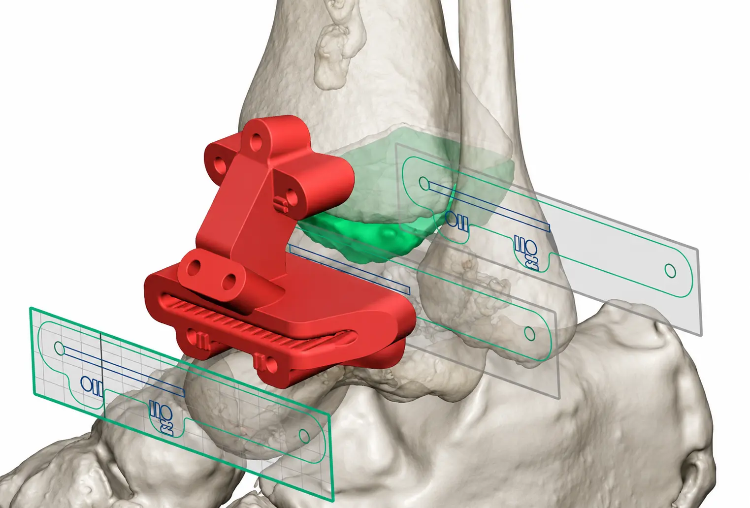 Vue 3D haute résolution d’un guide chirurgical personnalisé positionné sur les os de la cheville pour la planification préopératoire et le guidage précis des instruments chirurgicaux.