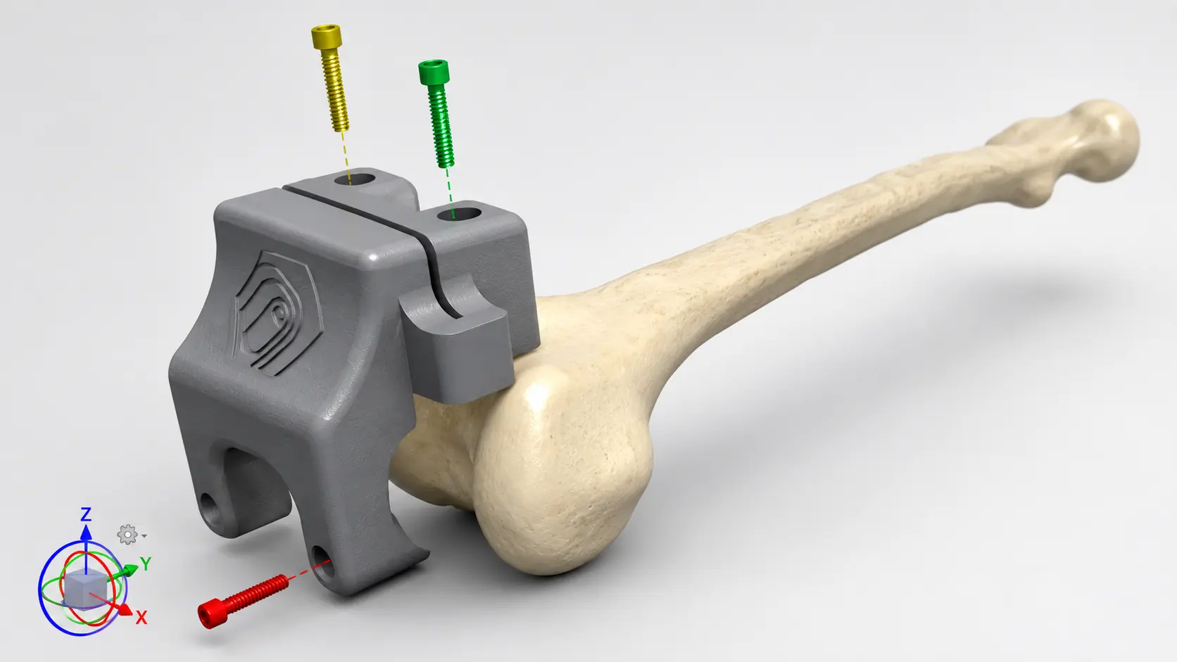 Visualisation 3D haute définition d’un guide chirurgical personnalisé fixé sur un os long avec repères de vissage pour la planification et la préparation d’une intervention orthopédique.